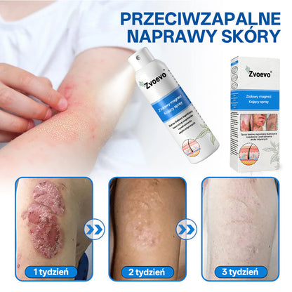 ✅ Oficjalny Sklep: Zvoevo® Magnezowy Ziołowy Spray na Łuszczycę ⚕️ Certyfikowany przez FDA (Łagodzi łuszczycę i egzemę, poprawia infekcje bakteryjne w okolicach intymnych, leczy trądzik i brodawki, łagodzi ból stawów i ból neuropatyczny)