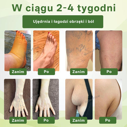 [ Efekty już w 7 dni ]👨‍⚕️ Croaie® Krem na Obrzęki i Żylaki (Certyfikat GMP UE • Opracowany na obrzęki, żylaki i słabe krążenie krwi 🦵)