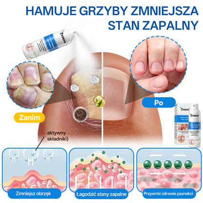 ✅ Oficjalny Sklep: Zvoevo® Magnezowy Ziołowy Spray na Łuszczycę ⚕️ Certyfikowany przez FDA (Łagodzi łuszczycę i egzemę, poprawia infekcje bakteryjne w okolicach intymnych, leczy trądzik i brodawki, łagodzi ból stawów i ból neuropatyczny)